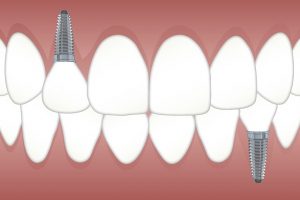 Minőségi fog implantátum